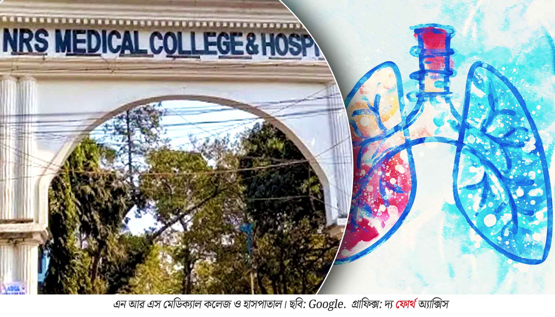 ১১ লিটার স্যালাইনে ‘ধোয়া’ হল ফুসফুস, মৃত্যুর মুখ থেকে ফিরলেন রোগী!